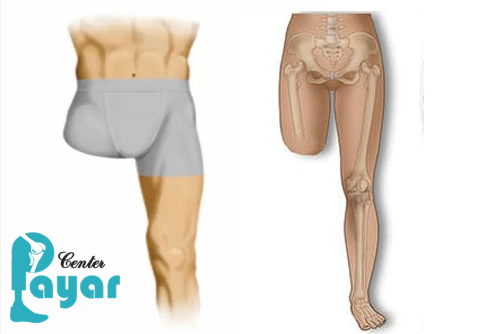 در مورد انواع قطع عضو (آمپوتاسیون) چه میدانید؟