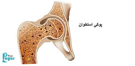 علائم و علت و درمان پوکی استخوان و پایار