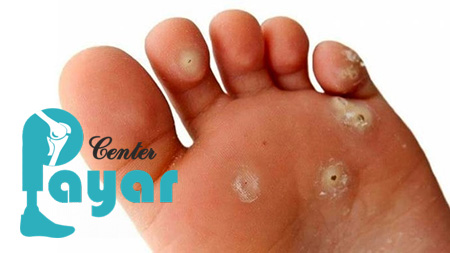 فرق زگیل و میخچه از نظر هزینه درمان چقدر است؟