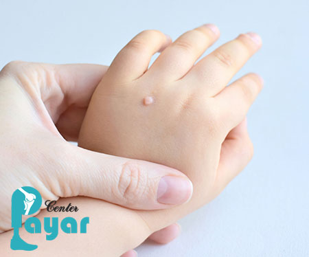 فرق زگیل و میخچه چیست