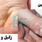 فرق زگیل و میخچه در چیست؟⭐(علت و درمان زگیل و میخچه)