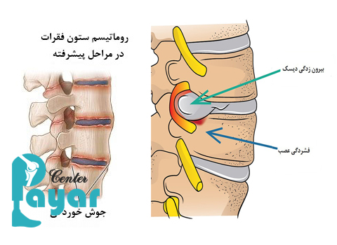 آیا میدانید تفاوت دیسک کمر با روماتیسم ستون فقرات چیست؟