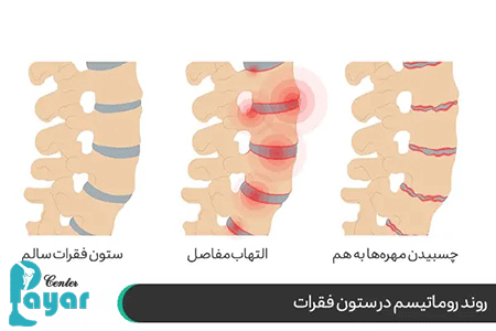 پیشگیری از روماتیسم ستون فقرات