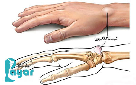کیست گانگلیون مچ دست چیست