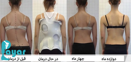 تاثیر بریس میلواکی در درمان اسکولیوز