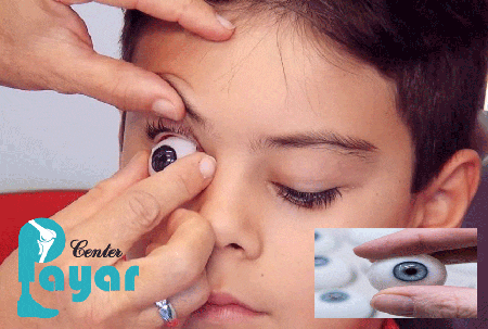 نحوه ساخت پروتز چشم در کلینیک ارتوپدی فنی پایار
