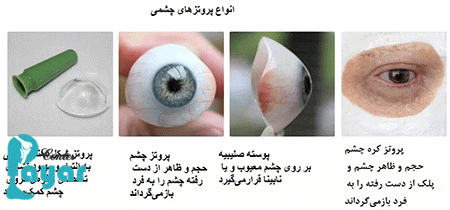 7 تا از عوارض پروتز چشم که باید بدانید