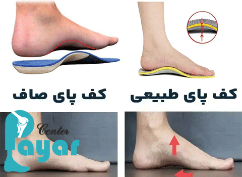 درمان صافی کف پا کودکان با کفی طبی پای صاف را جدی بگیرید
