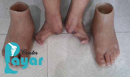 قیمت پروتز مچ پا بیشتر است یا قیمت پروتز پنجه پا؟