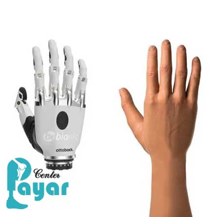 قیمت پروتز دست مصنوعی چند است؟