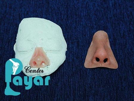 مزیت های پروتز بینی چیست