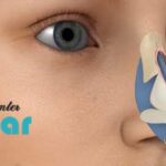 پروتز بینی بدون جراحی⭐عمل بینی بدون جراحی چگونه است؟