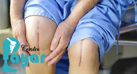 آنچه باید در مورد هزینه پروتز زانو با بیمه تکمیلی بفرمائید.