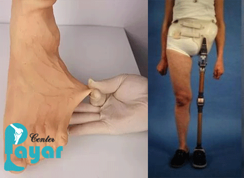 انواع پاهای مصنوعی در کلینیک تخصصی پا در غرب تهران