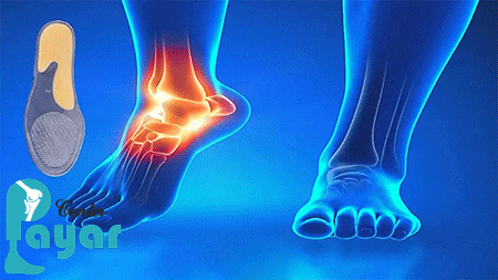 علت مراجعه به کلینیک های ارتوپدی فنی برای ساخت کفی طبی خار پاشنه