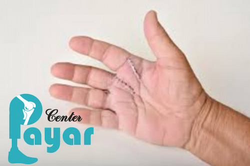 میزان درصد موفقیت پیوند انگشت