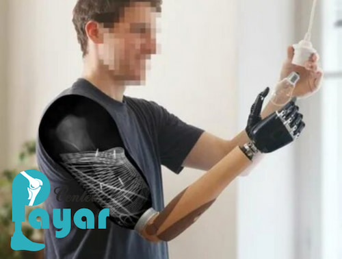 موفقیت پیوند دست مصنوعی