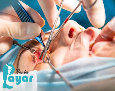 آیا میدانید که عمل تخلیه چشم چند ساعت طول می کشد؟