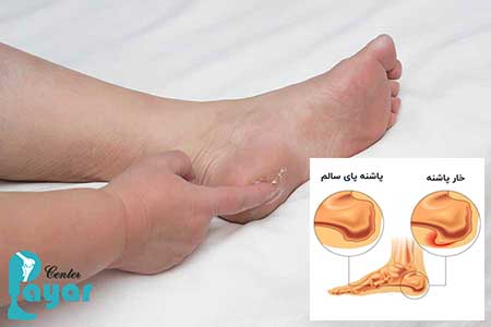 از کجا بفهمیم خار پاشنه داریم؟100 درصد کاربردی