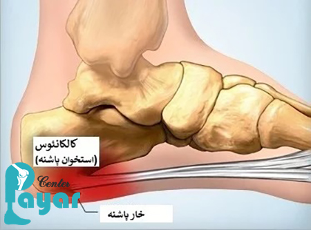 اگر خار پاشنه درمان نشود چه میشود؟ سریع ترین روش برای درمان خار پاشنه چیست؟