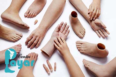 آیا در مورد نکات مراقبتی از پروتز بالای زانو چیزی شنیده اید؟