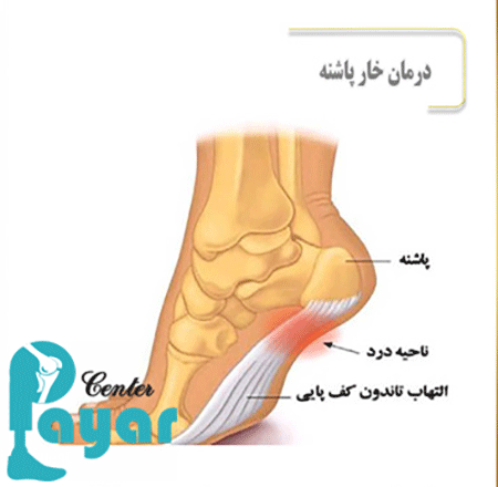 در مورد 7 روش قطعی برای پیشگیری از خار پاشنه چه میدانید