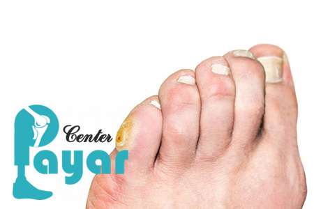 پاسخ به سوال برای درمان میخچه پا در منزل چه کنیم؟
