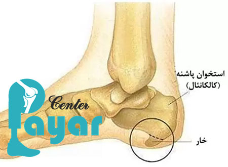 همه چیز در رابطه با پیشگیری از خار پاشنه