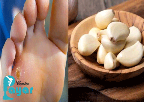 آیا درمان میخچه با سیر امکان پذیر است