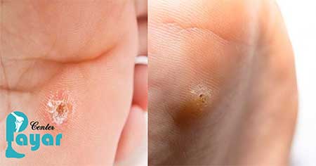 آیا میخچه خطرناک است؛ میخچه را جدی بگیرید