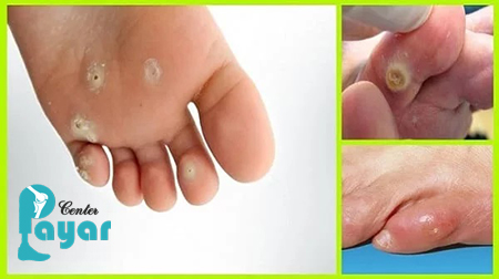 آیا میخچه خطرناک است؟میخچه را جدی بگیرید