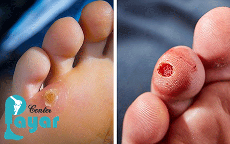 آیا میخچه خطرناک است؟ میخچه را جدی بگیرید!