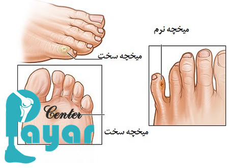 آیا میخچه خطرناک است و اینکه از کجا بفهمیم میخچه خوب شده است؟