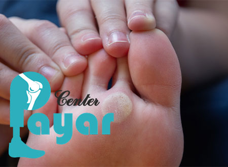 آیا میخچه خطرناک است؟اگر میخچه درمان نشود چه میشود؟