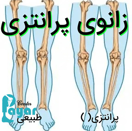 قیمت کفش طبی برای پای پرانتزی با اسکن کف پا چقدر است؟