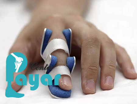 بازسازی انگشتان قطع شده چیست و ارتباط آن با پروتز انگشت دست چیست؟