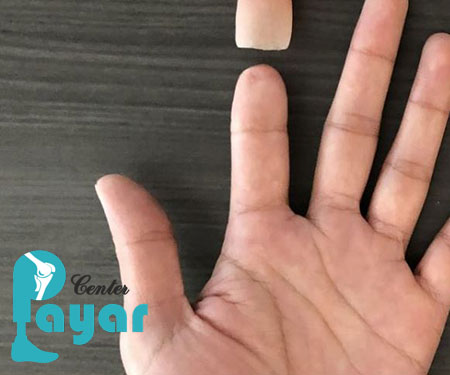 سیاه شدن انگشت بعد از پیوند، به دلیل نصب و ساخت پروتز انگشت دست است؟
