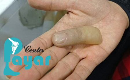 نحوه نگهداری صحیح از پروتز انگشت دست سیلیکونی چیست؟