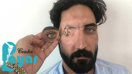 آیا حالت چشم فرد روی قیمت پروتز چشم تهران تاثیر می گذارد؟