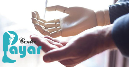 بررسی پروتز مچ دست بیونیک