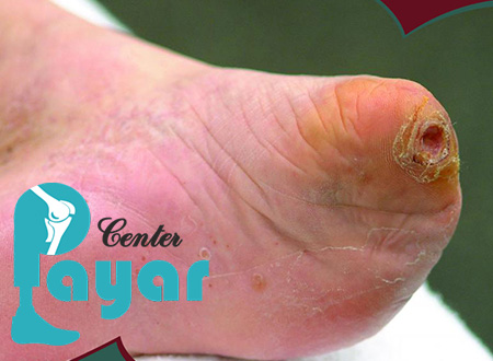 همه چیز در رابطه با نحوه جلوگیری از قطع پای دیابتی