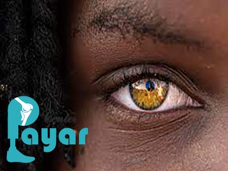 هزینه ی ساخت پروتز چشم (چشم مصنوعی) در پایار