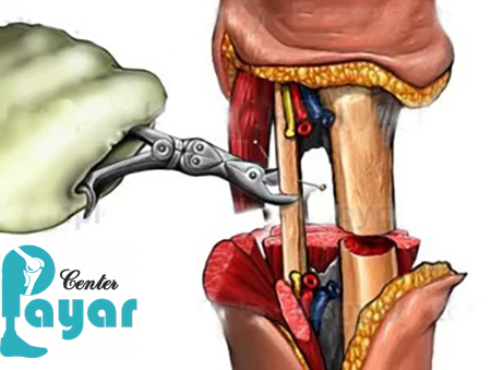 آمپوتاسیون پای دیابتی به چه شکل انجام می شود؟