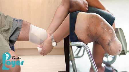 آیا میدانید دلایل قطع پا زیر زانو چیست