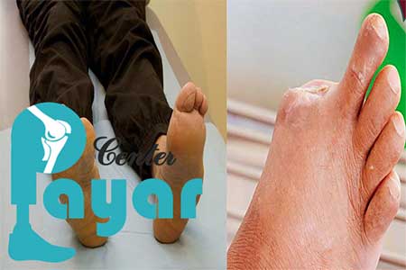 آیا میدانید قطع انگشت پای دیابتی چیست؟