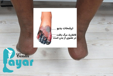 انواع آمپوتاسیون پای دیابتی