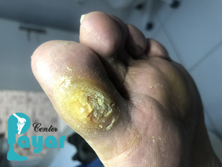 بدترین عوارض قطع انگشت پا چیست