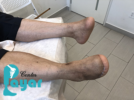 در مورد قطع انگشت پای دیابتی چه میدانید؟
