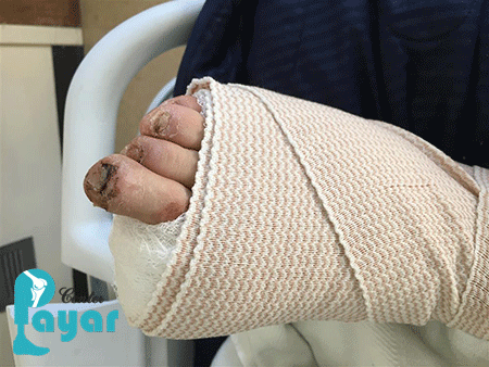 عوارض ناشی از آمپوتاسیون پای دیابتی