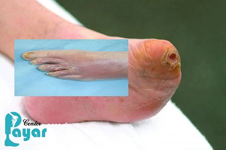 قطع انگشت پای دیابتی چیست؟ چگونه صورت می گیرد؟